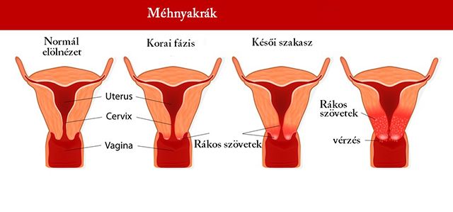 Mi a méhnyak kiürülése?