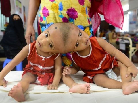 Fejüknél összenőtt bangladesi sziámi ikreket műtöttek meg Budapesten