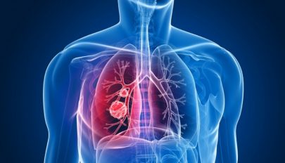 Több mint 11 ezer új tüdőrák-esetet jegyeztek tavaly Romániában