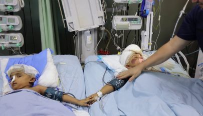 Tucatnyi műtétet kell még elvégezni a szétválasztott bangladesi sziámi ikreken