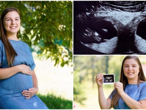 Két külön méhben fejlődő két gyerekkel terhes egy brit nő