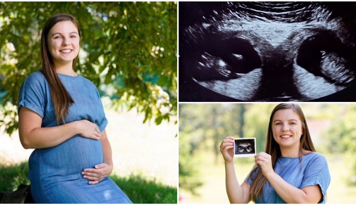 Két külön méhben fejlődő két gyerekkel terhes egy brit nő