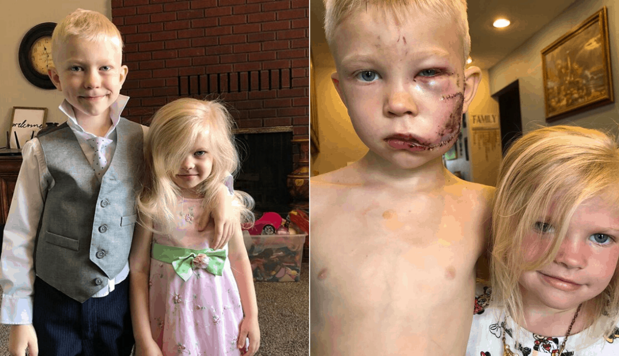 Kutyatámadástól mentette meg kishúgát a hatéves fiú