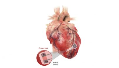 Felszívódó, átmenetileg használatos pacemakert fejlesztettek ki