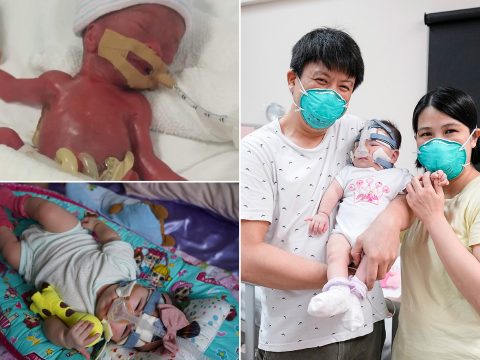 Egy év után hazavihették szülei a világ legkisebb újszülöttjeként világra jött babát