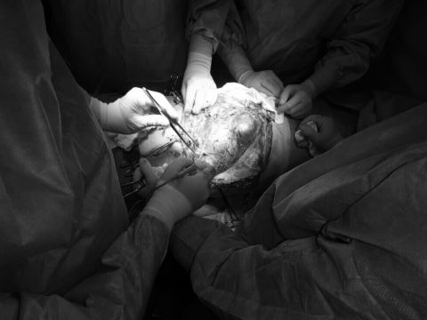 12 kilogrammos daganatot távolítottak el egy férfi testéből a marosvásárhelyi kórházban