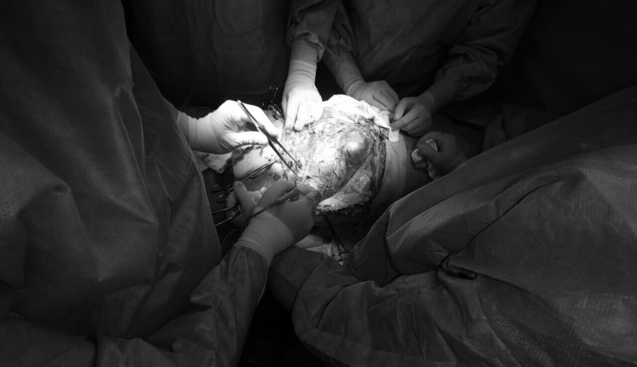 12 kilogrammos daganatot távolítottak el egy férfi testéből a marosvásárhelyi kórházban